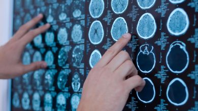 I risultati lo confermano: i trapianti di staminali umane cerebrali contro la SLA sono sicuri