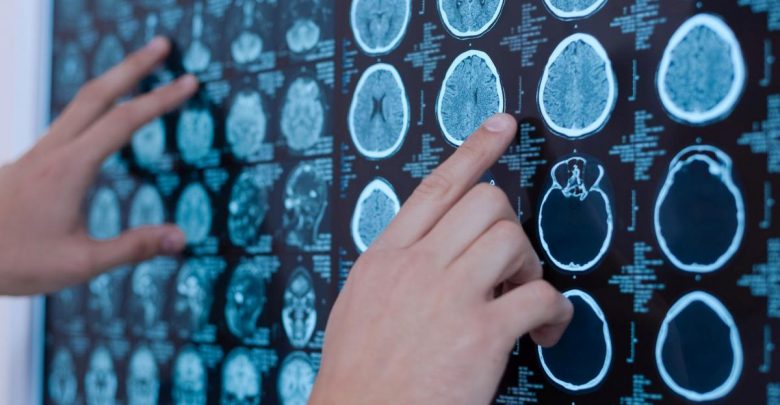 I risultati lo confermano: i trapianti di staminali umane cerebrali contro la SLA sono sicuri