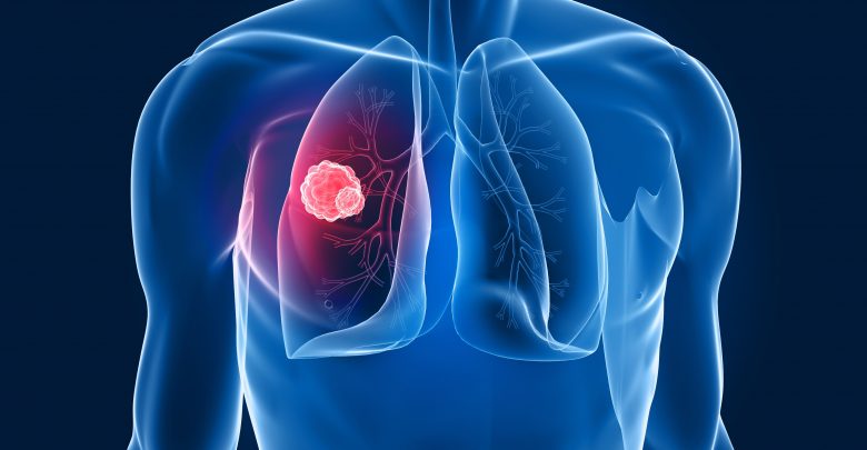 Un nuovo farmaco ridà speranza di vita a pazienti con tumore al polmone in stadio avanzato