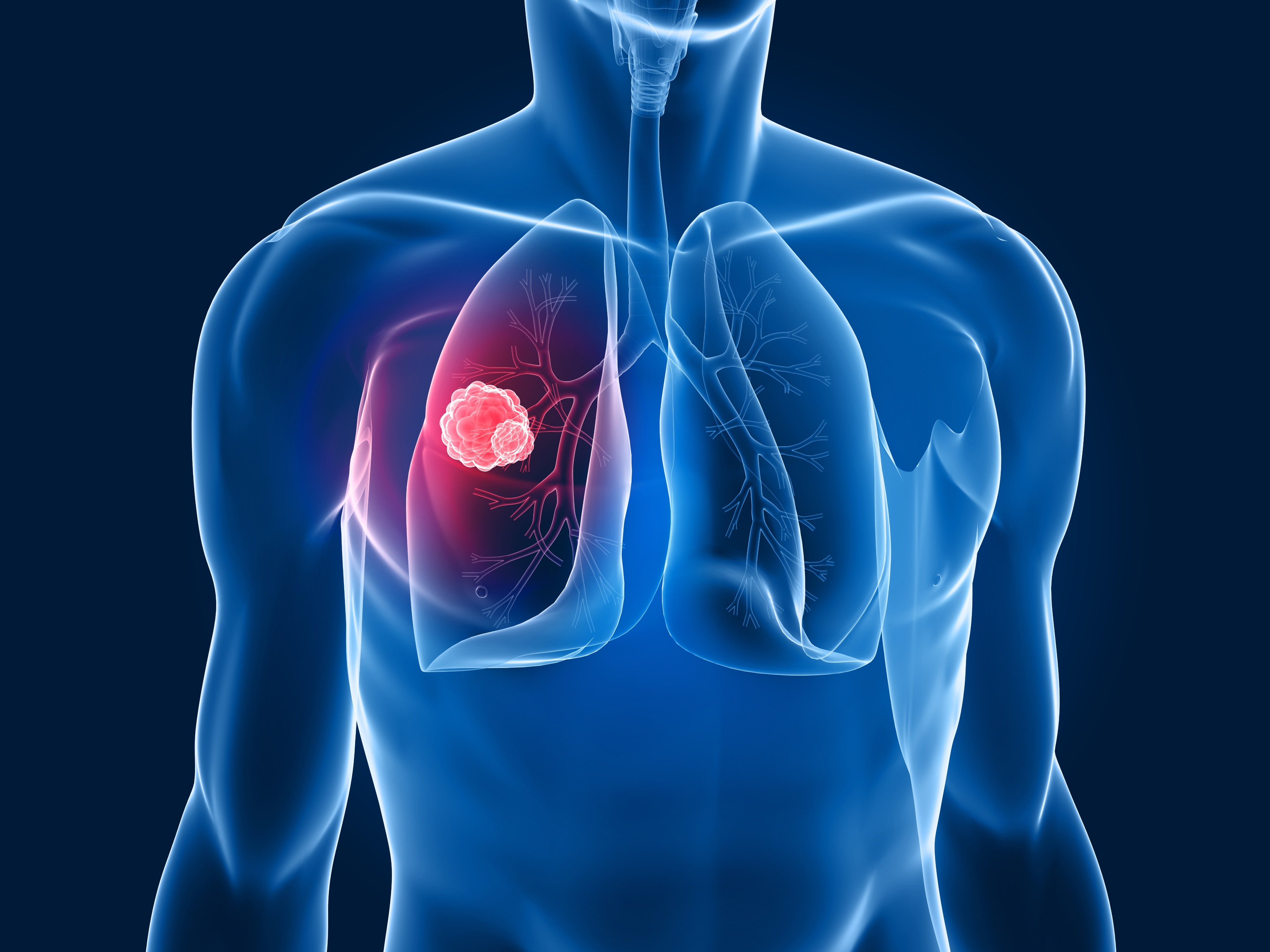 Un nuovo farmaco ridà speranza di vita a pazienti con tumore al polmone in stadio avanzato